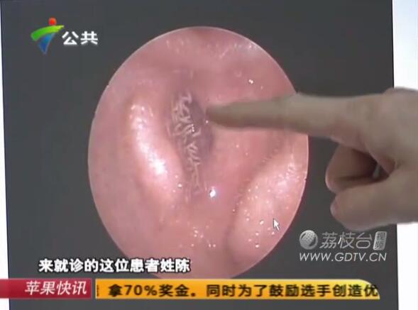 驚恐!男子耳內(nèi)長(zhǎng)滿白色爬蟲,撕咬耳道痛不欲生!