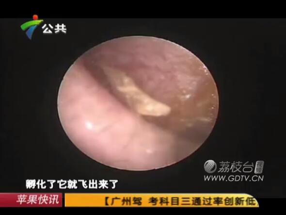 驚恐!男子耳內(nèi)長(zhǎng)滿白色爬蟲,撕咬耳道痛不欲生!