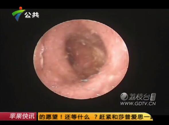驚恐!男子耳內(nèi)長(zhǎng)滿白色爬蟲,撕咬耳道痛不欲生!
