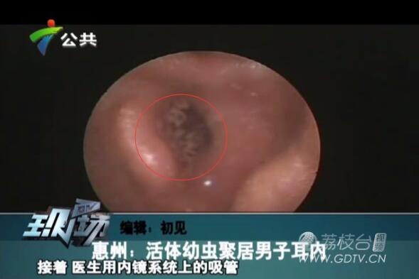 驚恐!男子耳內(nèi)長(zhǎng)滿白色爬蟲,撕咬耳道痛不欲生!
